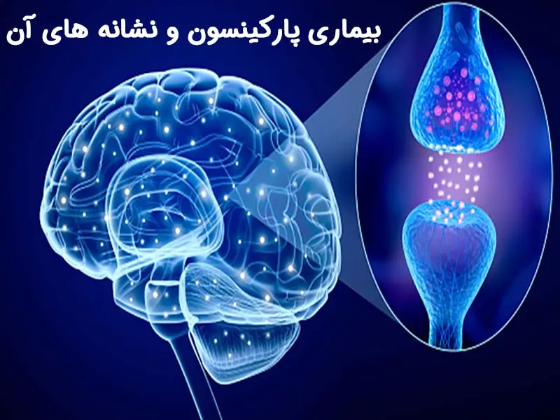 پارکینسون